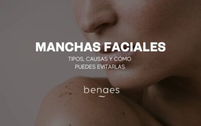 Manchas en la cara: tipos, causas y cómo evitarlas 