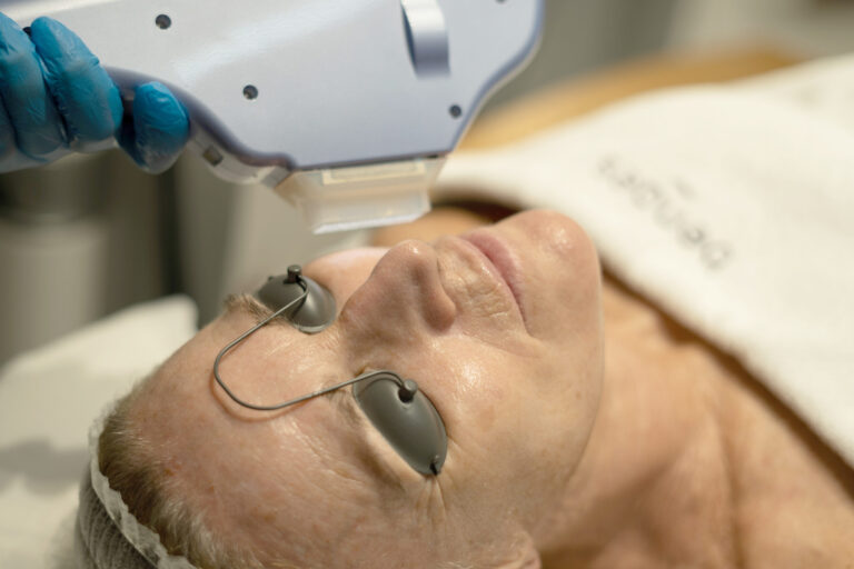 Rejuvenecimiento facial con IPL