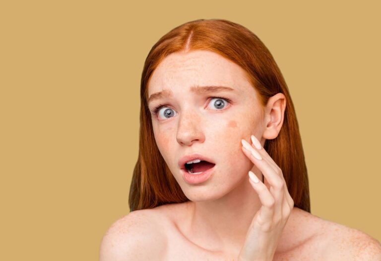 Tratamiento del melasma