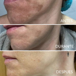 Peeling químico despigmentante