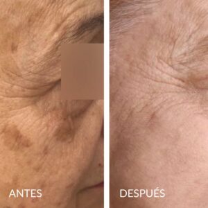Láser Fotona para manchas faciales