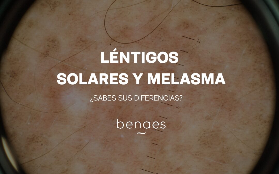 ¿Cuáles son las diferencias entre los léntigos solares y el melasma?