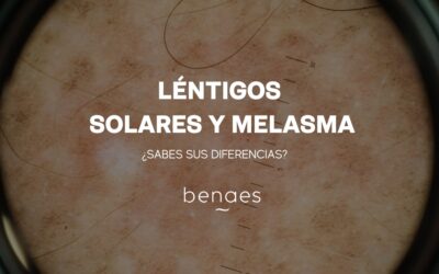 ¿Cuáles son las diferencias entre los léntigos solares y el melasma?