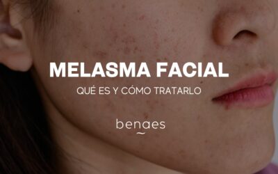 Melasma Facial: Qué es y cómo tratarlo