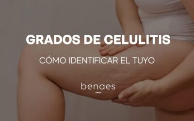 Grados de celulitis: cómo identificar el tuyo