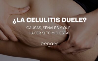 ¿La celulitis duele? Causas, señales y qué hacer si molesta