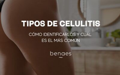 Tipos de celulitis: cómo identificarlos y cuál es más común