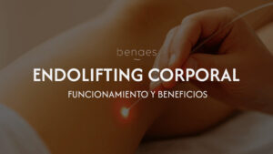 Endolifting corporal: qué es, cómo funciona y qué resultados ofrece