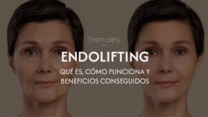 Endolifting: Qué es, cómo funciona y beneficios conseguidos