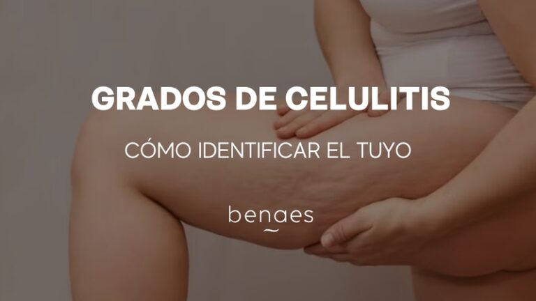 Grados de celulitis