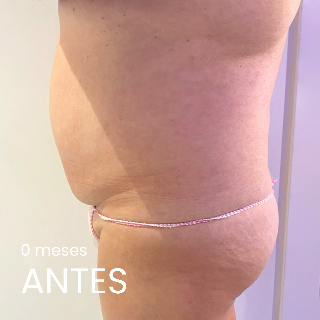antes adelgazamiento fármacos