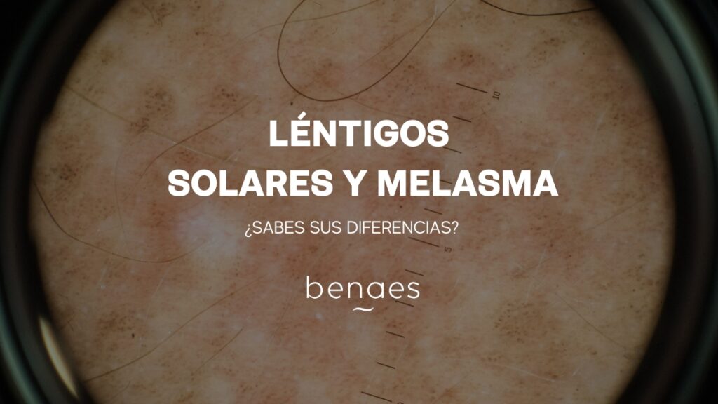 lentigos solares y melasma