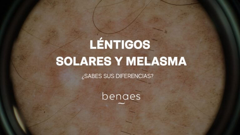 ¿Cuáles son las diferencias entre los léntigos solares y el melasma?