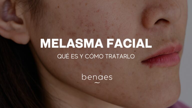 Melasma facial: qué es, por qué aparece y cómo eliminarlo