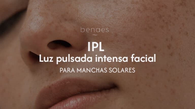 IPL para manchas solares
